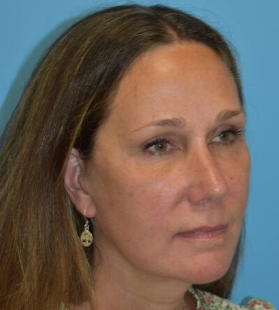 Endoscopic Brow Lift