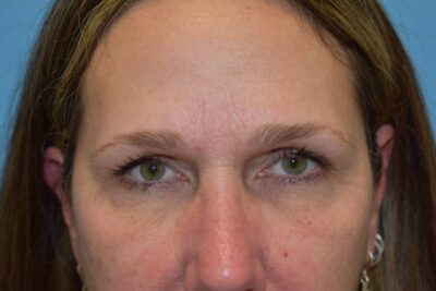 Endoscopic Brow Lift