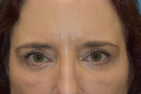 Blepharoplasty (Eyelid Surgery)