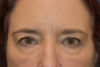 Blepharoplasty (Eyelid Surgery)