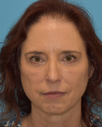 Blepharoplasty (Eyelid Surgery)