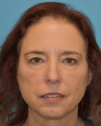 Blepharoplasty (Eyelid Surgery)