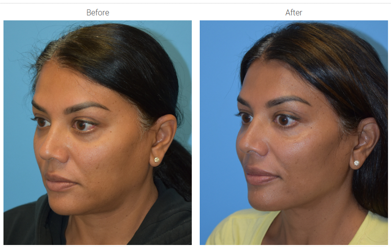 Facetite-before-after