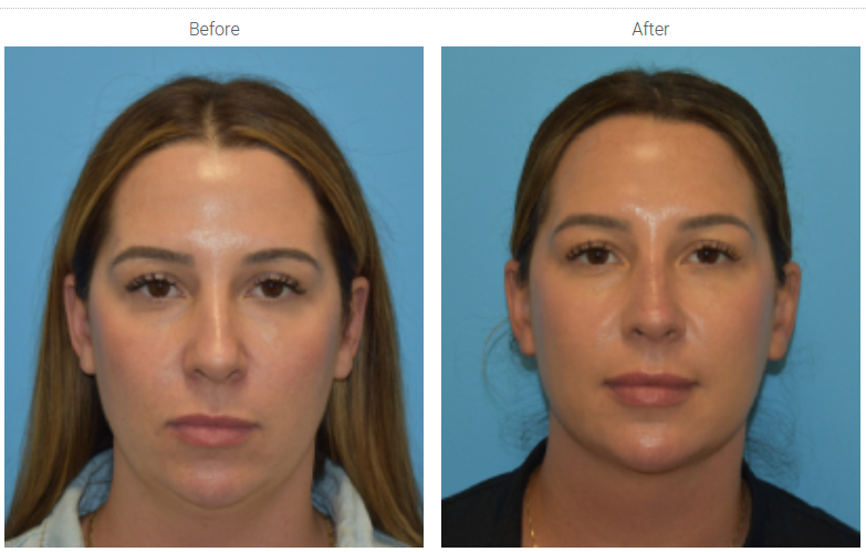 Facetite_Before_After