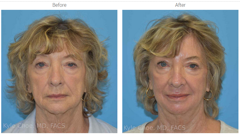Phenol Peel-before-after