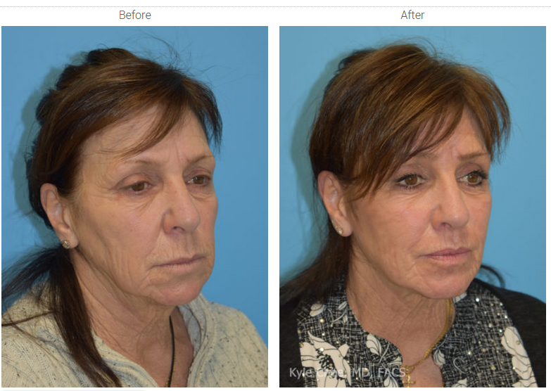 Phenol Peel_before_after
