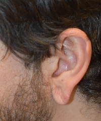 Ear Lobe Repair