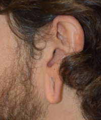 Ear Lobe Repair