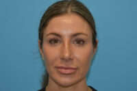 Endoscopic Brow Lift