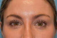 Endoscopic Brow Lift