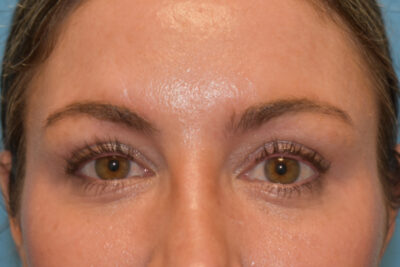 Endoscopic Brow Lift