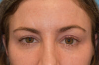 Endoscopic Brow Lift