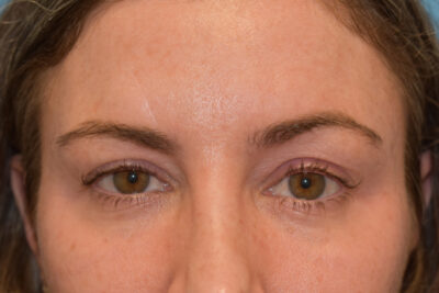 Endoscopic Brow Lift