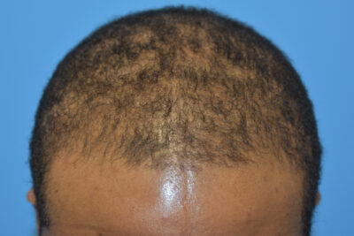 Hair Restoration