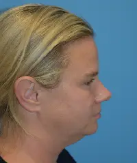 Facetite (Embrace)
