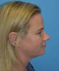 Facetite (Embrace)