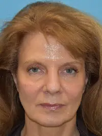 Facelift