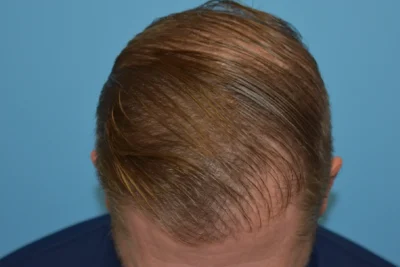 Hair Restoration
