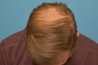 Hair Restoration