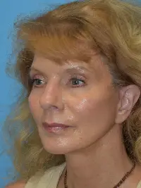 Facelift