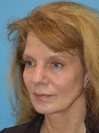 Facelift
