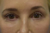 Blepharoplasty (Eyelid Surgery)