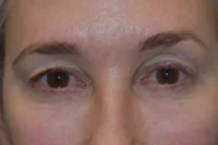 Blepharoplasty (Eyelid Surgery)