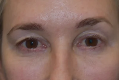 Blepharoplasty (Eyelid Surgery)