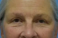 Blepharoplasty (Eyelid Surgery)