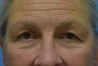 Blepharoplasty (Eyelid Surgery)