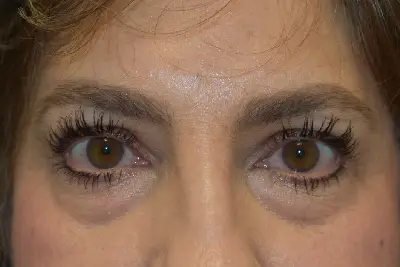 Blepharoplasty (Eyelid Surgery)