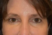 Endoscopic Brow Lift
