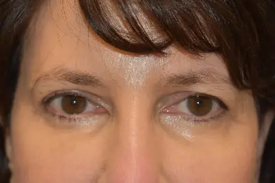 Endoscopic Brow Lift