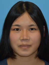 Rhinoplasty