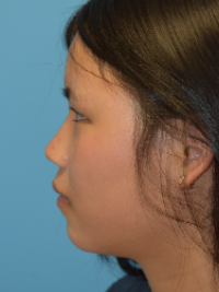 Rhinoplasty
