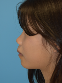 Rhinoplasty